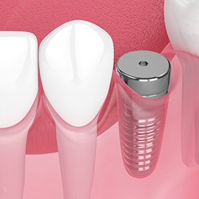 Illustration of an unrestored dental implant in Ramsey, NJ