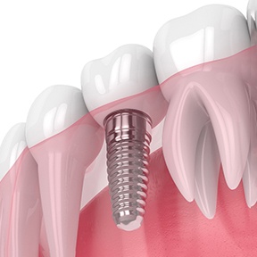 Illustration of dental implant in Ramsey, NJ with crown
