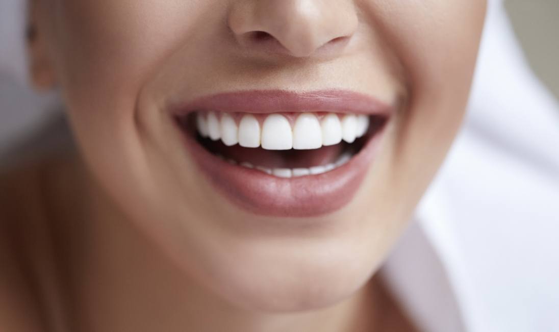 Close up of woman smiling with perfectly straight white teeth