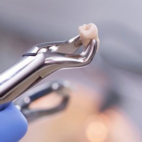 a dentist holding an extracted tooth with special forceps
