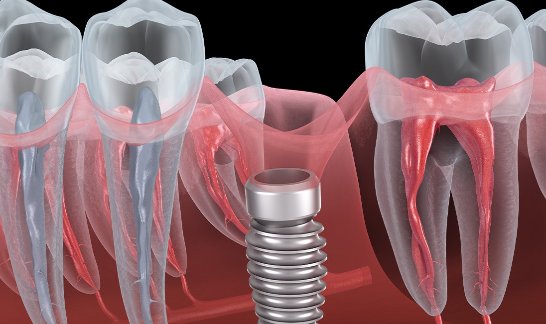 Failed dental implant