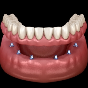 Six dental implants supporting a full implant denture