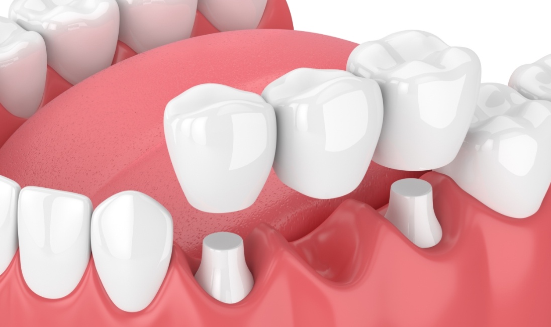 Animated dental bridge replacing a missing tooth