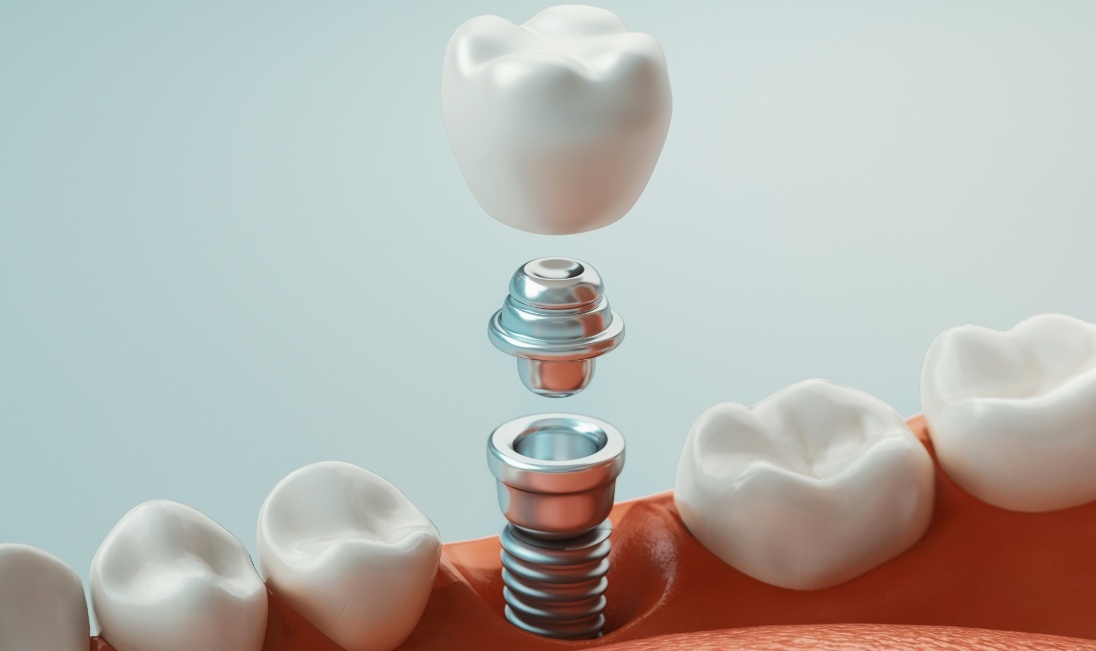 Animated dental implant with crown replacing a missing tooth