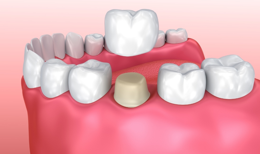 Animated dental crown being placed over a tooth