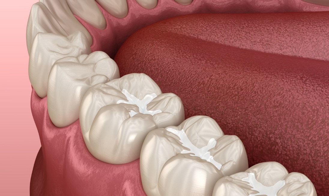 Animated row of teeth with tooth colored fillings