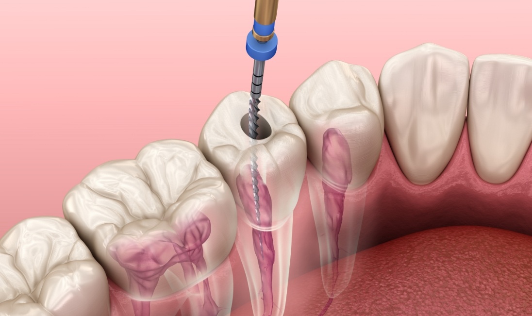 Animated dental tool treating the inside of a tooth