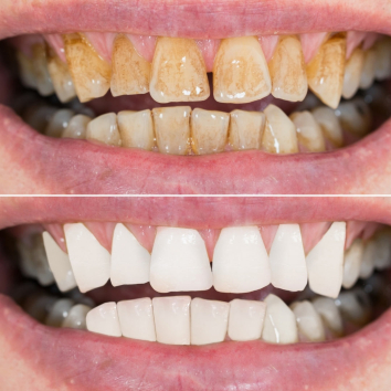 Close up of a smile before and after teeth whitening from Ramsey dentist