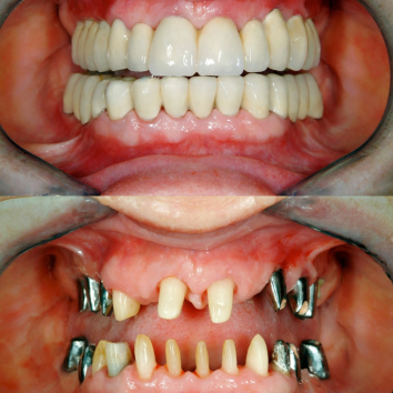 Photos of teeth before and after dental treatment