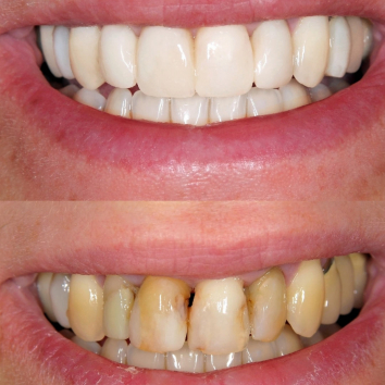 Before and after images of teeth of a cosmetic dental patient