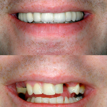 Photo of a smile before and after replacing a missing tooth
