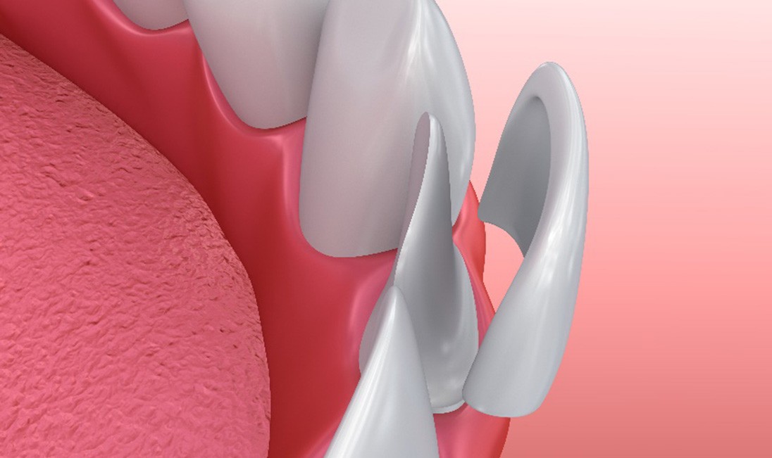 Illustration of veneer being placed on bottom, front tooth