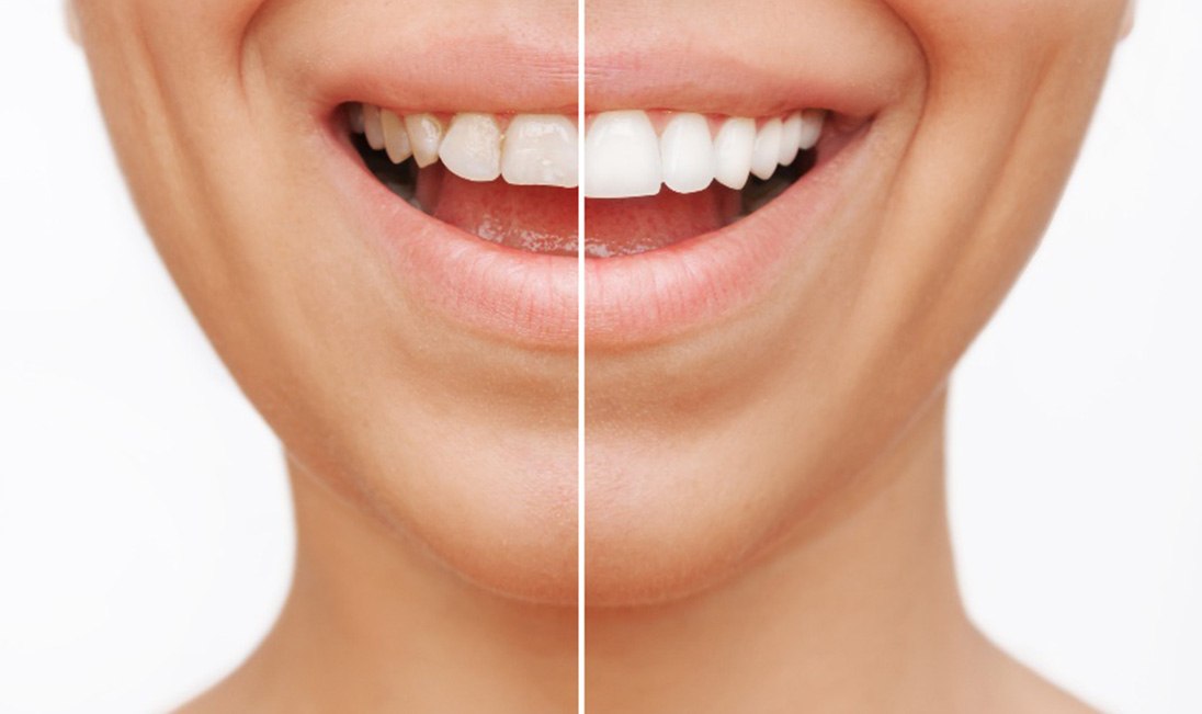 Closeup of patient's smile before and after veneers
