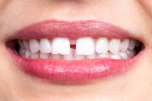 Close-up of smile with gap between two front teeth