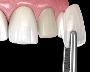 Placing a temporary veneer on a tooth